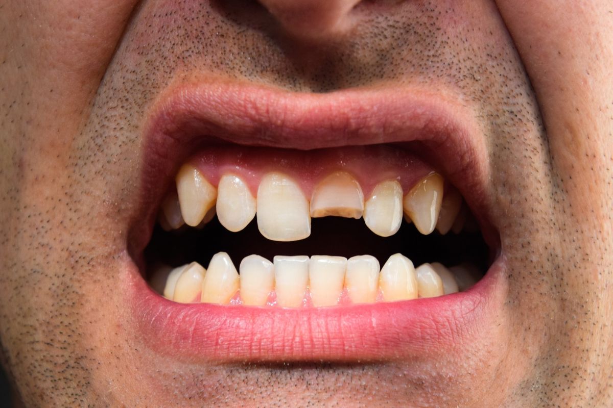 close-up of a man with a cracked tooth showing dental damage